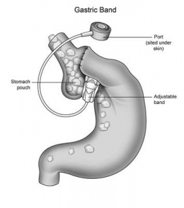 gastricbandpic